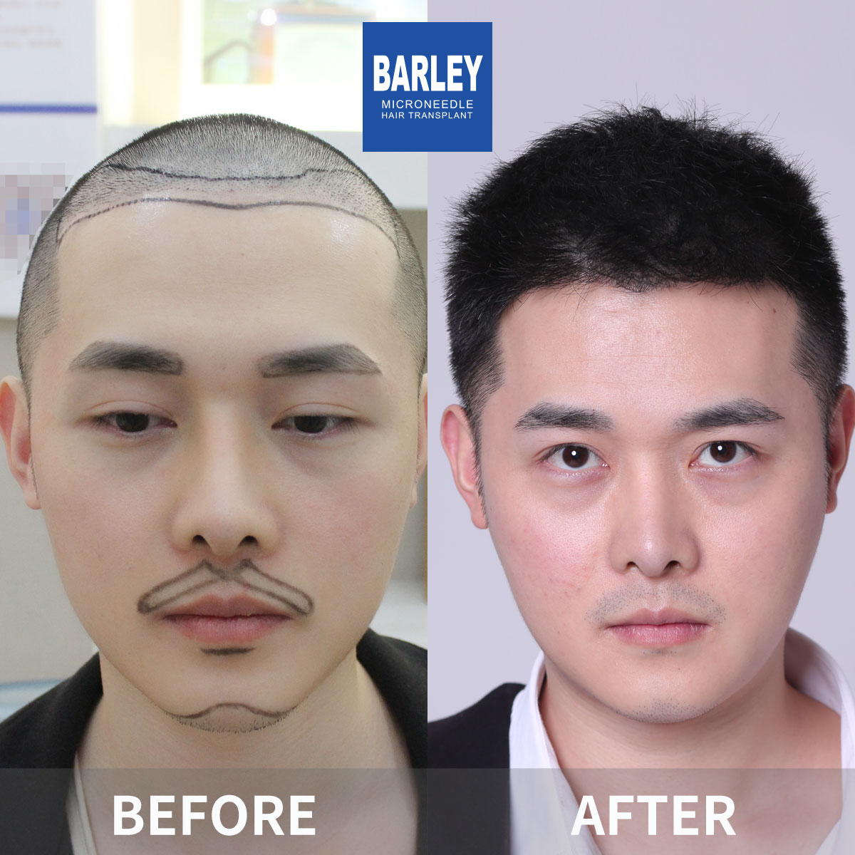 禿頭修復成果
