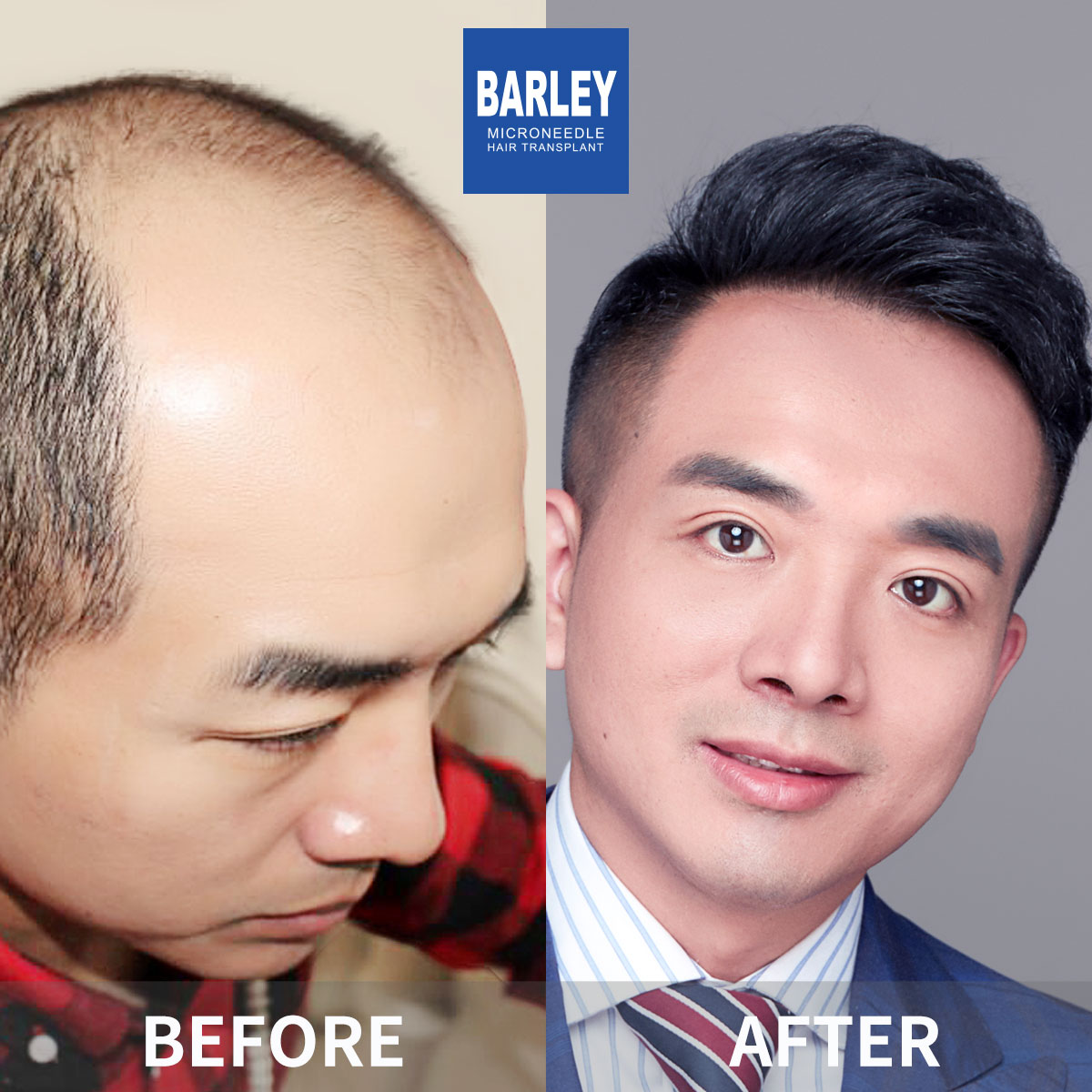 男性禿頭