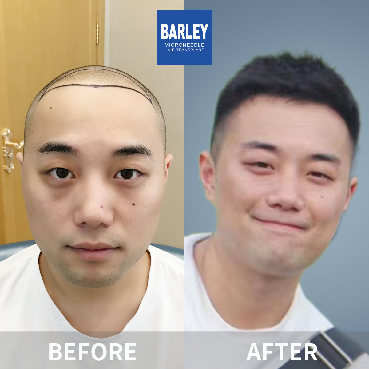 男性禿頭