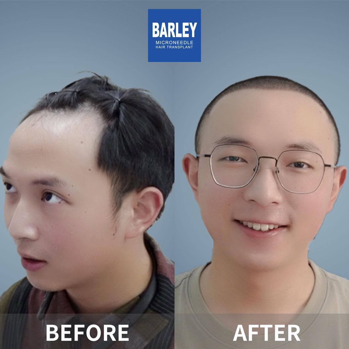 男性髮際線