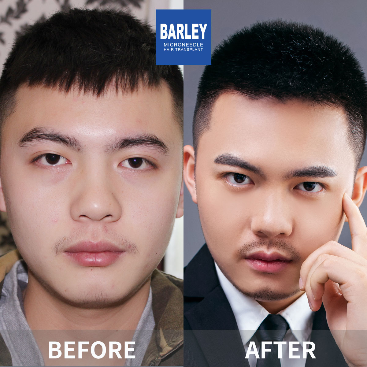 男性髮際線