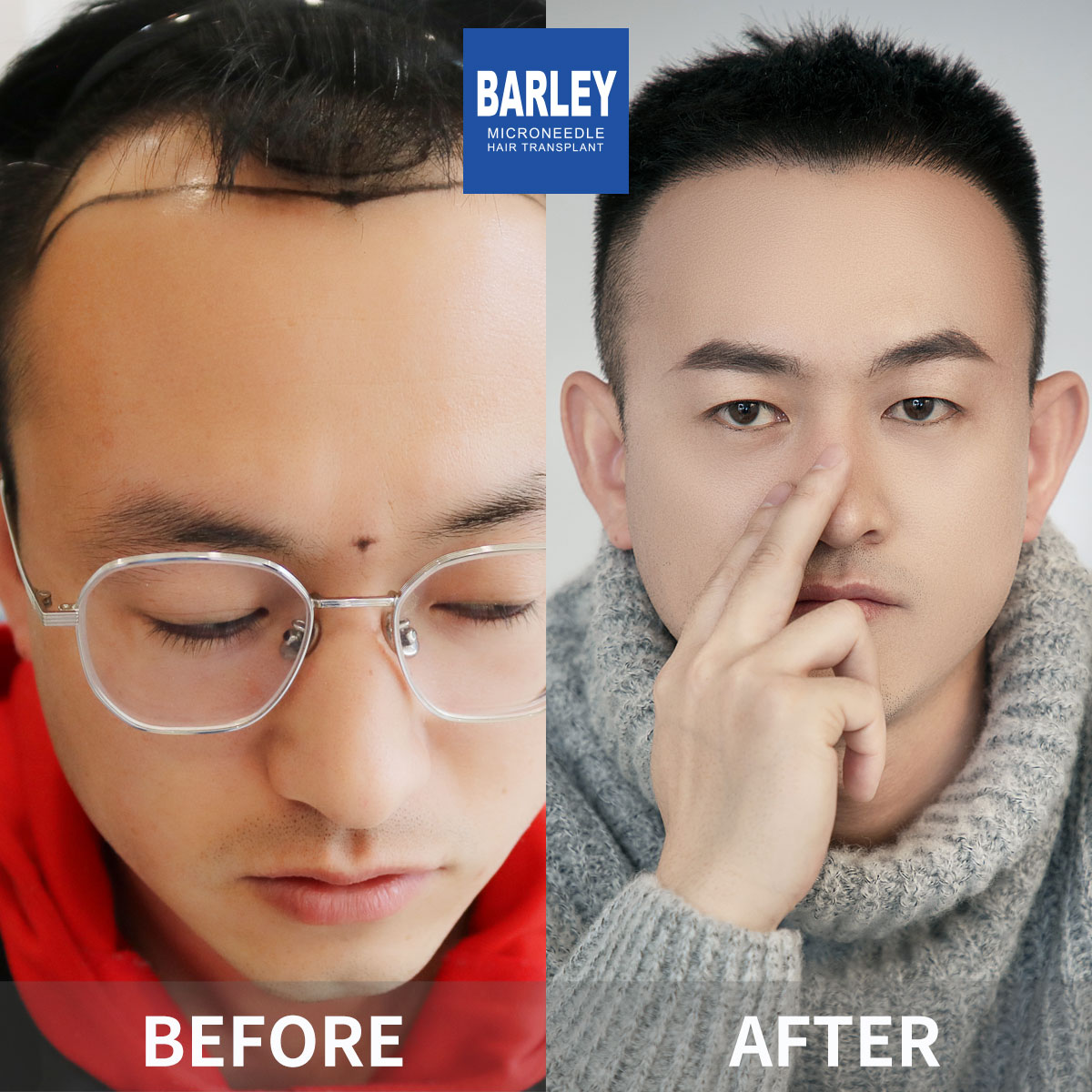 男性髮際線