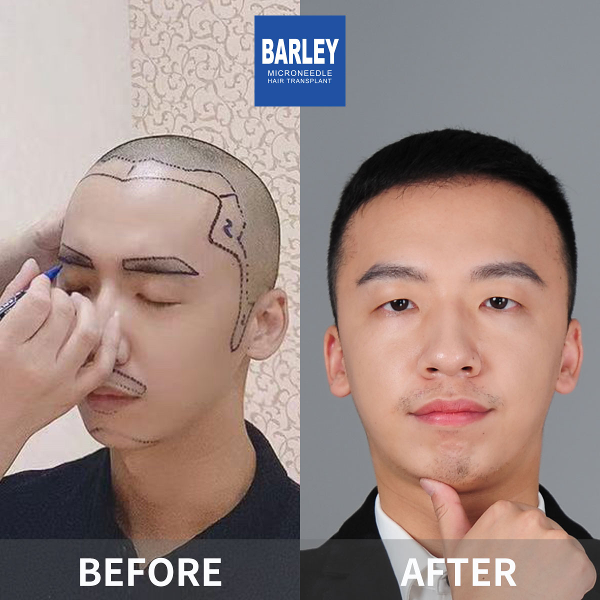 男性髮際線