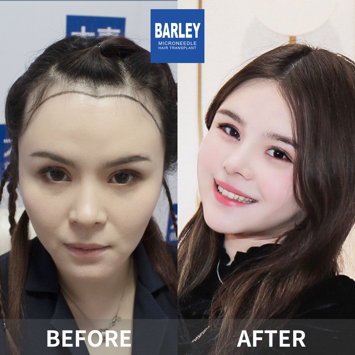 女性髮際線植髮成果